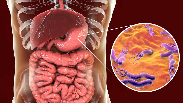 Este es el medicamento que previene el cáncer de estómago