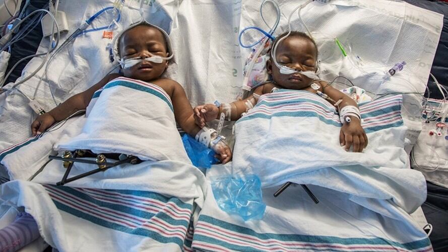 Siamesas nigerianas separadas en hospital en Tennessee . Foto: Associated Press - AP