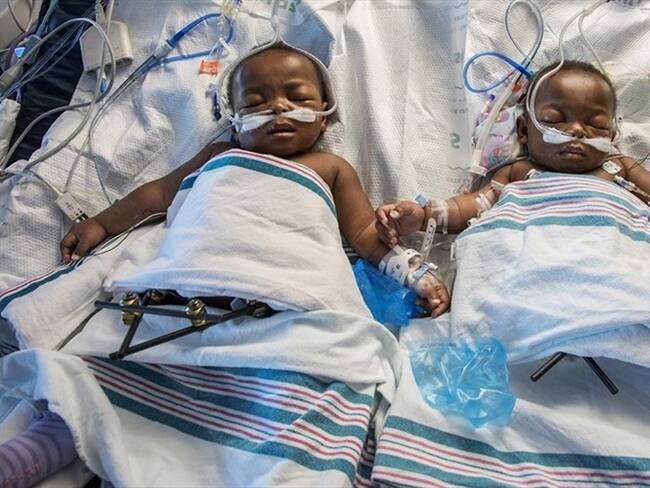 Siamesas nigerianas separadas en hospital en Tennessee . Foto: Associated Press - AP