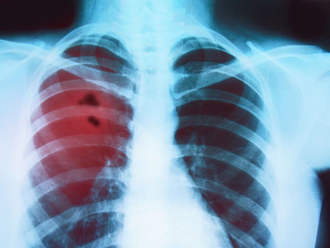 Cáncer de Pulmón. Foto: Getty Images