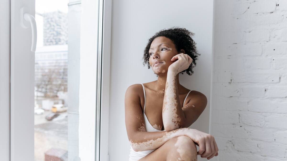 ¿Cómo tratar el vitiligo? Dermatólogo brindó algunas recomendaciones