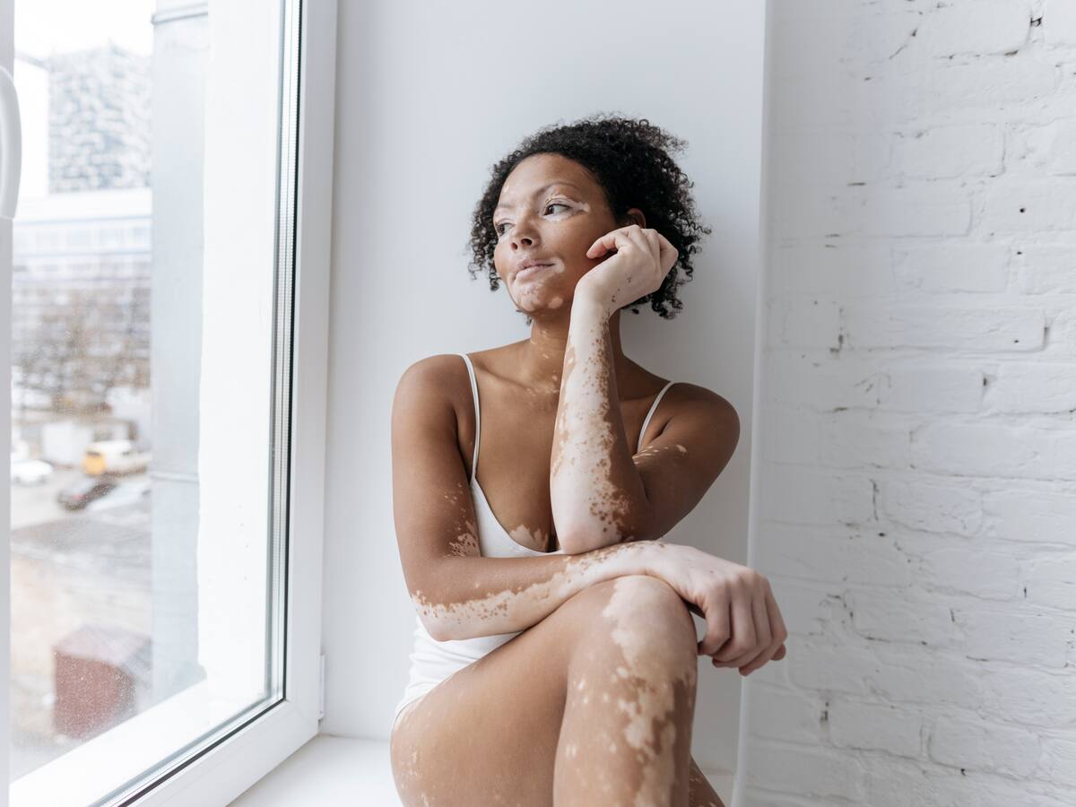 ¿Cómo tratar el vitiligo? Dermatólogo brindó algunas recomendaciones