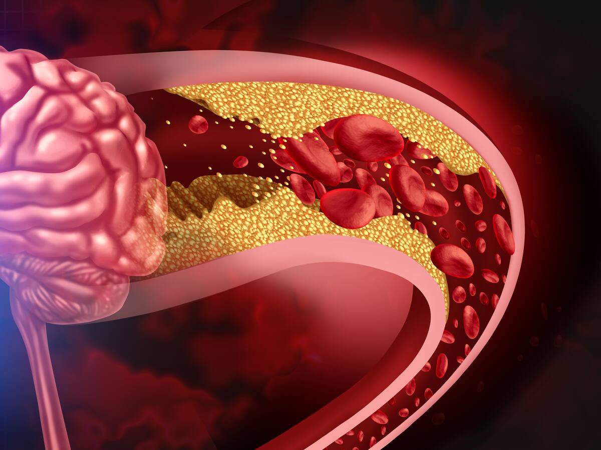 Accidente cerebrovascular: ¿Qué es y cuáles son los síntomas de alerta?