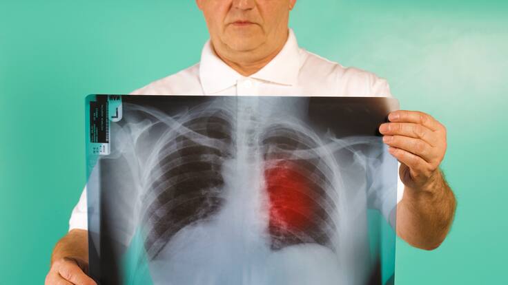 Estos son algunos signos de alarma que indicarían que se podría tener cáncer de pulmón