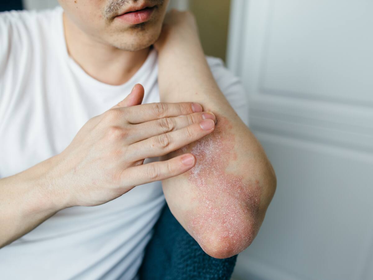 Melasma y manchas en la piel: experto reveló el mejor tratamiento para el cuidado