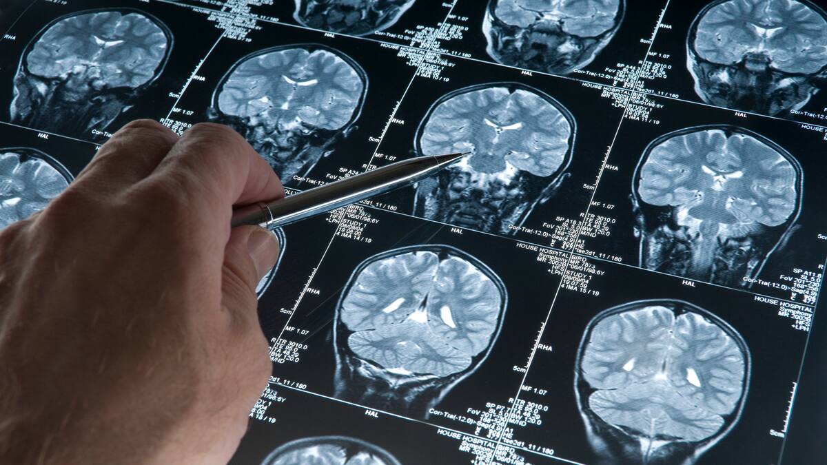 ¿Todos los tumores cerebrales son malignos? Experto revela signos de alarma