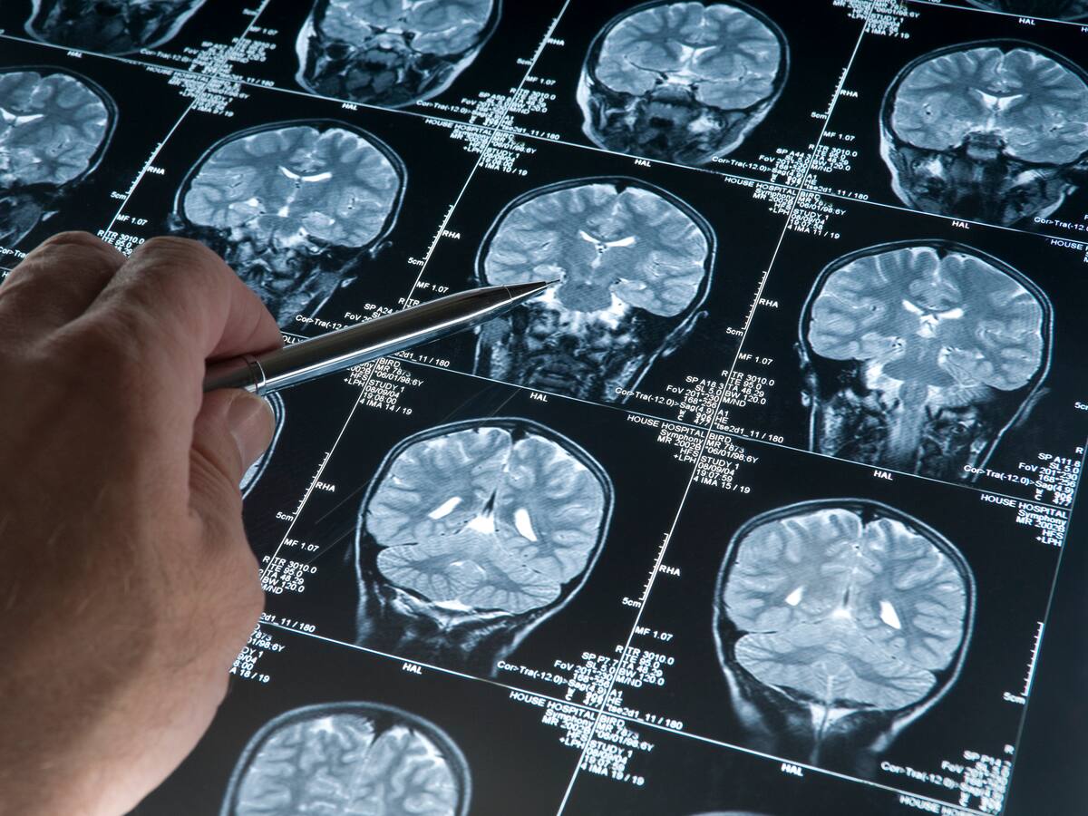 ¿Todos los tumores cerebrales son malignos? Experto revela signos de alarma