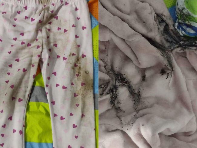 Menor de dos años resultó quemada con pólvora en Bucaramanga. Fotos: Alcalde de Bucaramanga