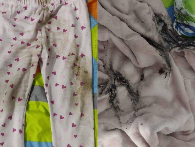 Menor de dos años resultó quemada con pólvora en Bucaramanga. Fotos: Alcalde de Bucaramanga