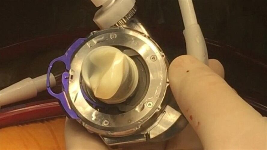 Se cumplen cinco años desde que se implantó el primer corazón artificial.. Foto: FCV