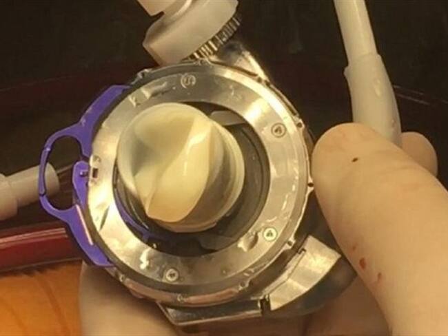 Se cumplen cinco años desde que se implantó el primer corazón artificial.. Foto: FCV