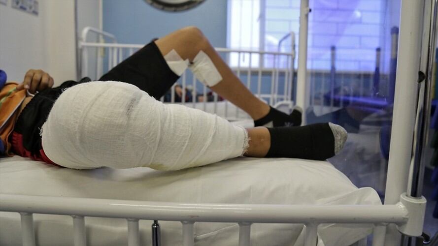 Quemados con pólvora durante diciembre 2019. Foto: Colprensa