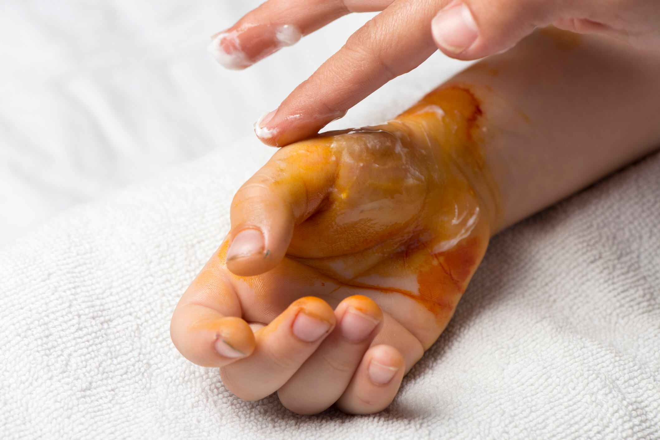 Child Hand With Second Degree Burn