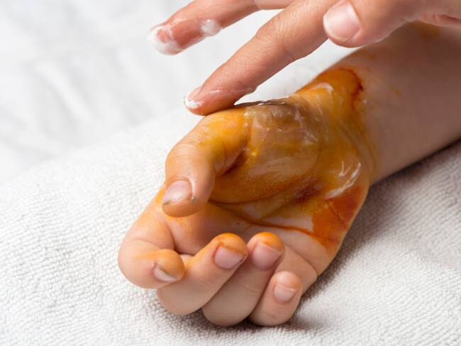 Child Hand With Second Degree Burn