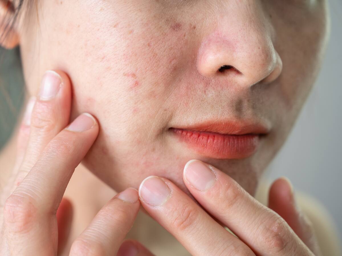 Listado de alimentos que lo ayudarán a tener un equilibrio hormonal y evitar el acné