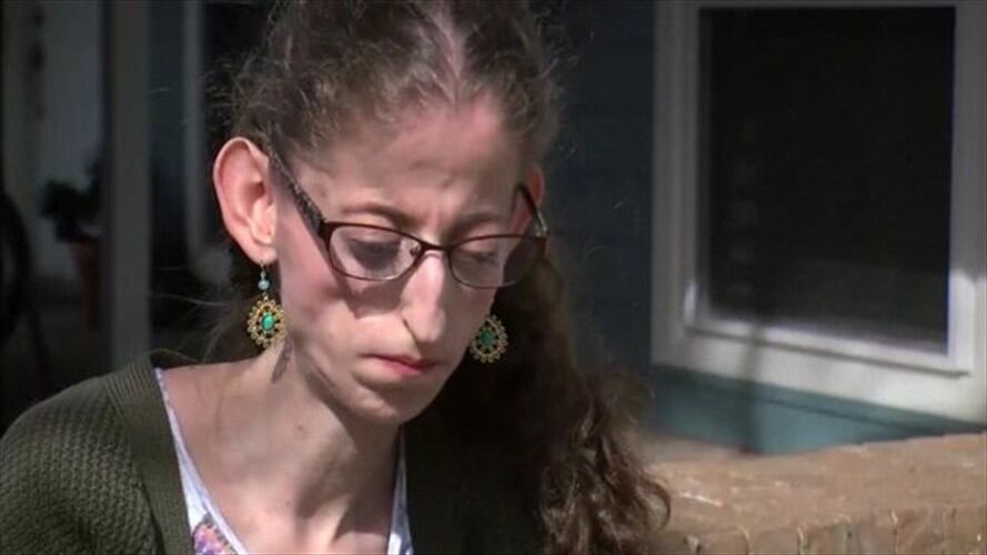 El síndrome de Abby Solomon está causado por una mutación genética. Foto: BBC Mundo