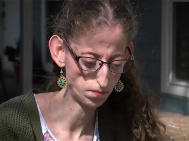 El síndrome de Abby Solomon está causado por una mutación genética. Foto: BBC Mundo