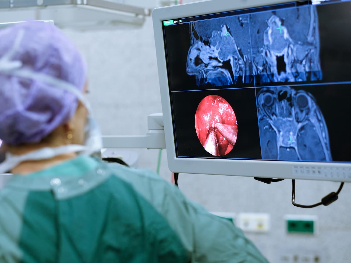 ¿Cómo ayuda el 5-ALA con la extracción de tumores cerebrales? Neurocirujano explicó