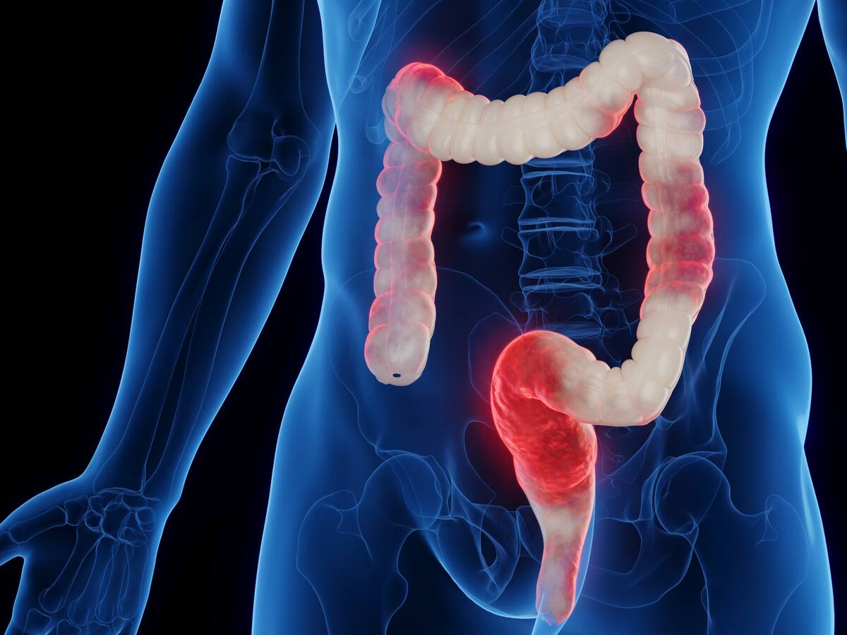 ¿La colitis es igual al síndrome de colon irritable? Experta responde