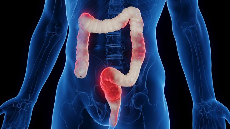 ¿La colitis es igual al síndrome de colon irritable? Experta responde