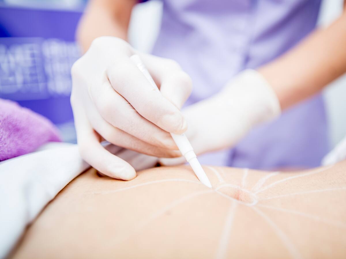 Esto es lo que debe saber sobre la lipomarcación: cirujano plástico entregó detalles