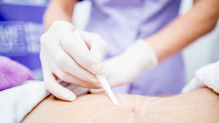 Esto es lo que debe saber sobre la lipomarcación: cirujano plástico entregó detalles