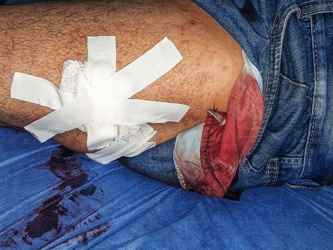 Dos trabajadores más resultaron heridos. Crédito: Red de Apoyo Cauca. 