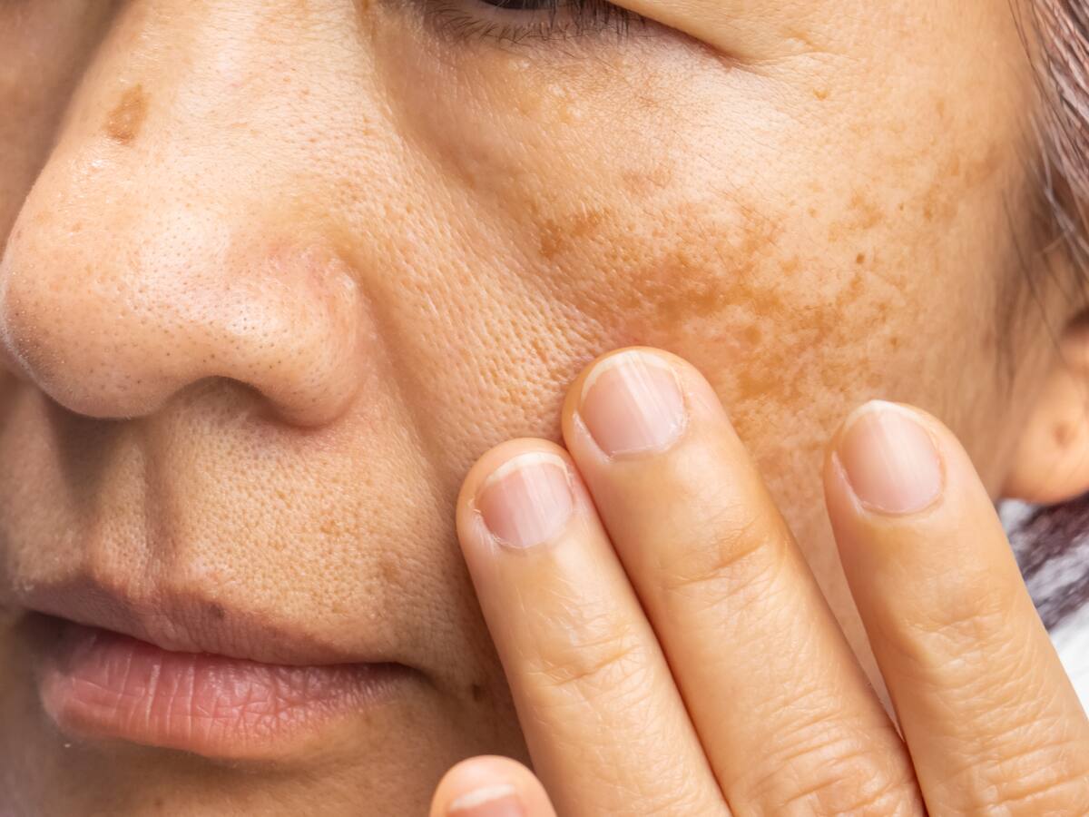 Melasma: ¿qué es, por qué aparece y cuál es el tratamiento?