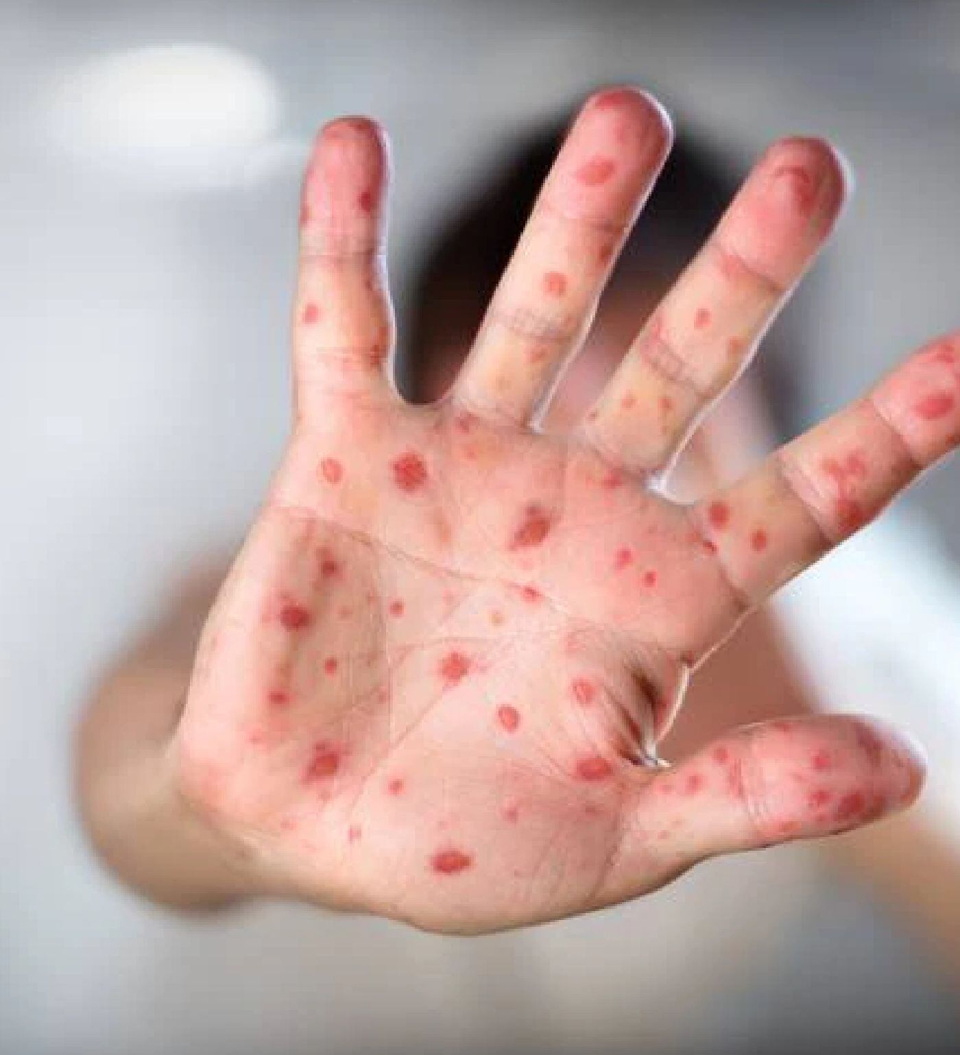 Viruela del mono/: GettyImages / Romolo Tavani