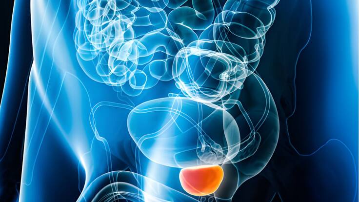 Urólogo aclaró todos los mitos relacionados con el cáncer de próstata