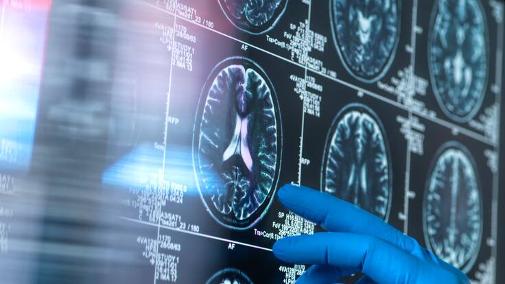 Acciones que pueden estar envejeciendo su cerebro: ¿cómo rejuvenecerlo? Estudio lo reveló