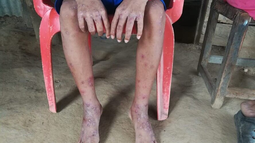 Más de 40 casos de escabiosis han sido atendidos en zona rural de Montería. Foto: Cortesía