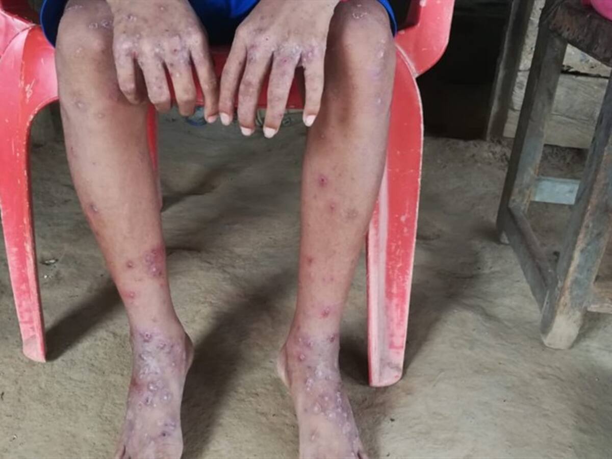 Más de 40 casos de escabiosis han sido atendidos en zona rural de Montería