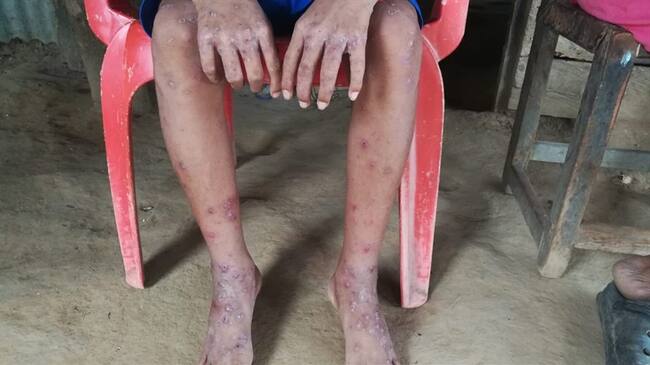 Más de 40 casos de escabiosis han sido atendidos en zona rural de Montería. Foto: Cortesía