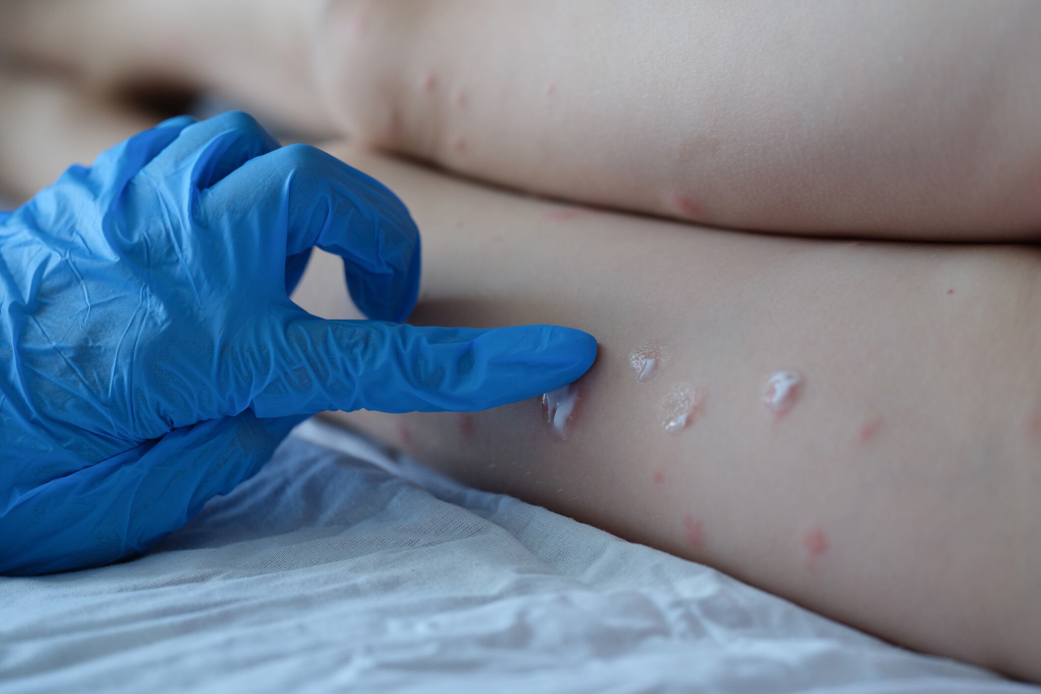 Doctor in protective medical gloves applying cream to red rash of skin of child feet closeup. Diagnosis and treatment of chickenpox in children concept
