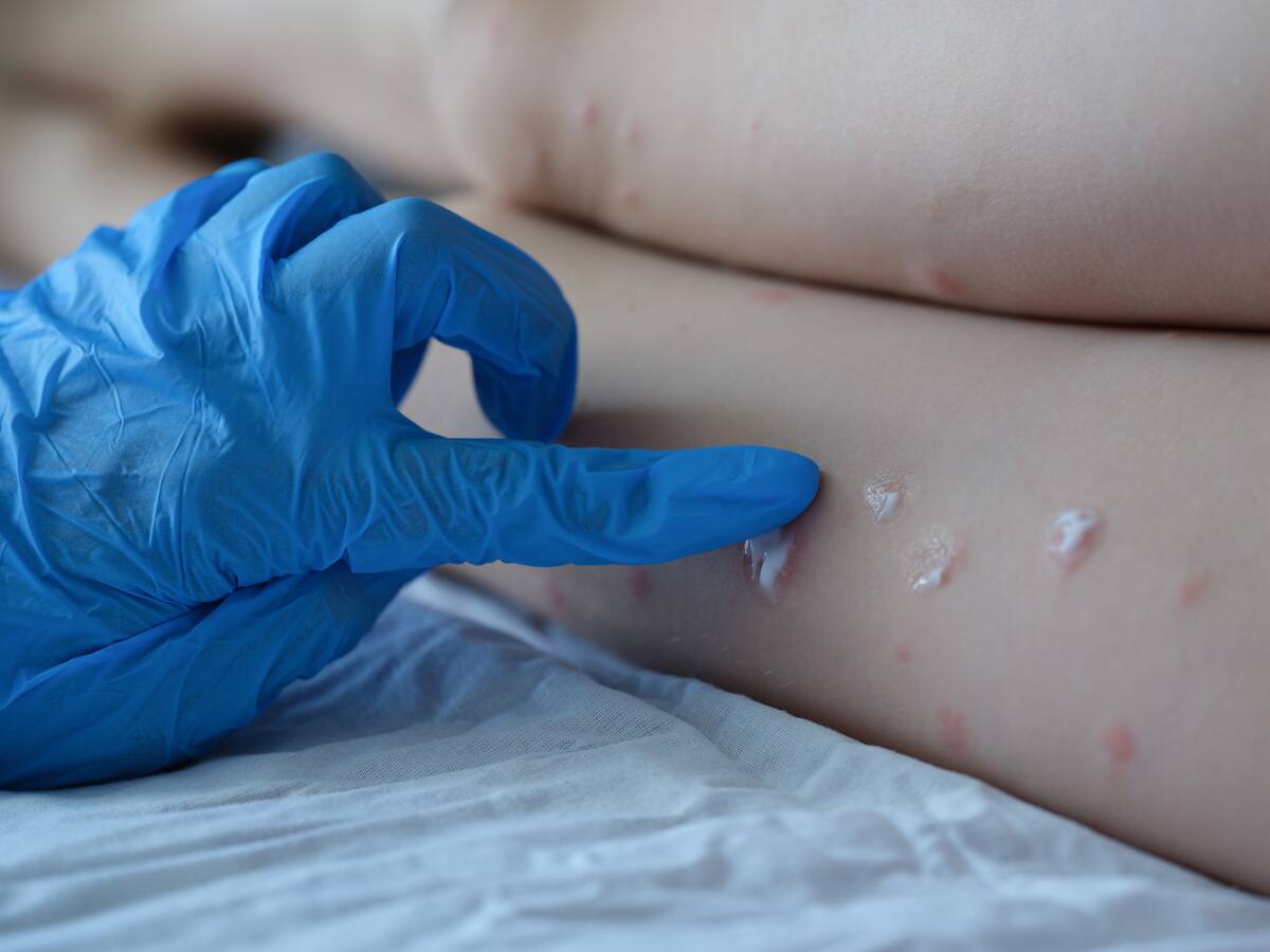 Viruela del mono en Colombia: confirman tres casos en Bogotá y Medellín