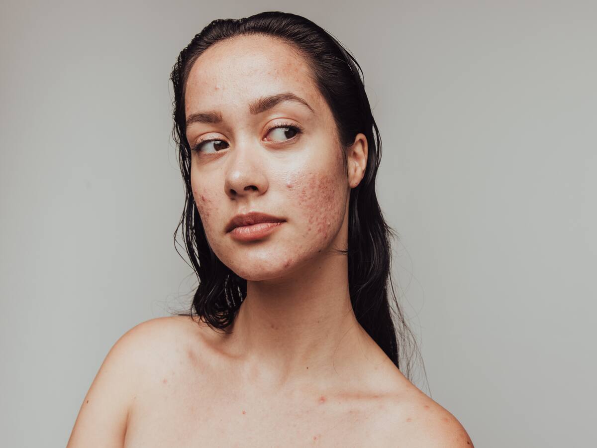 ¿Los parches para el acné son recomendables? Dermatóloga dio detalles