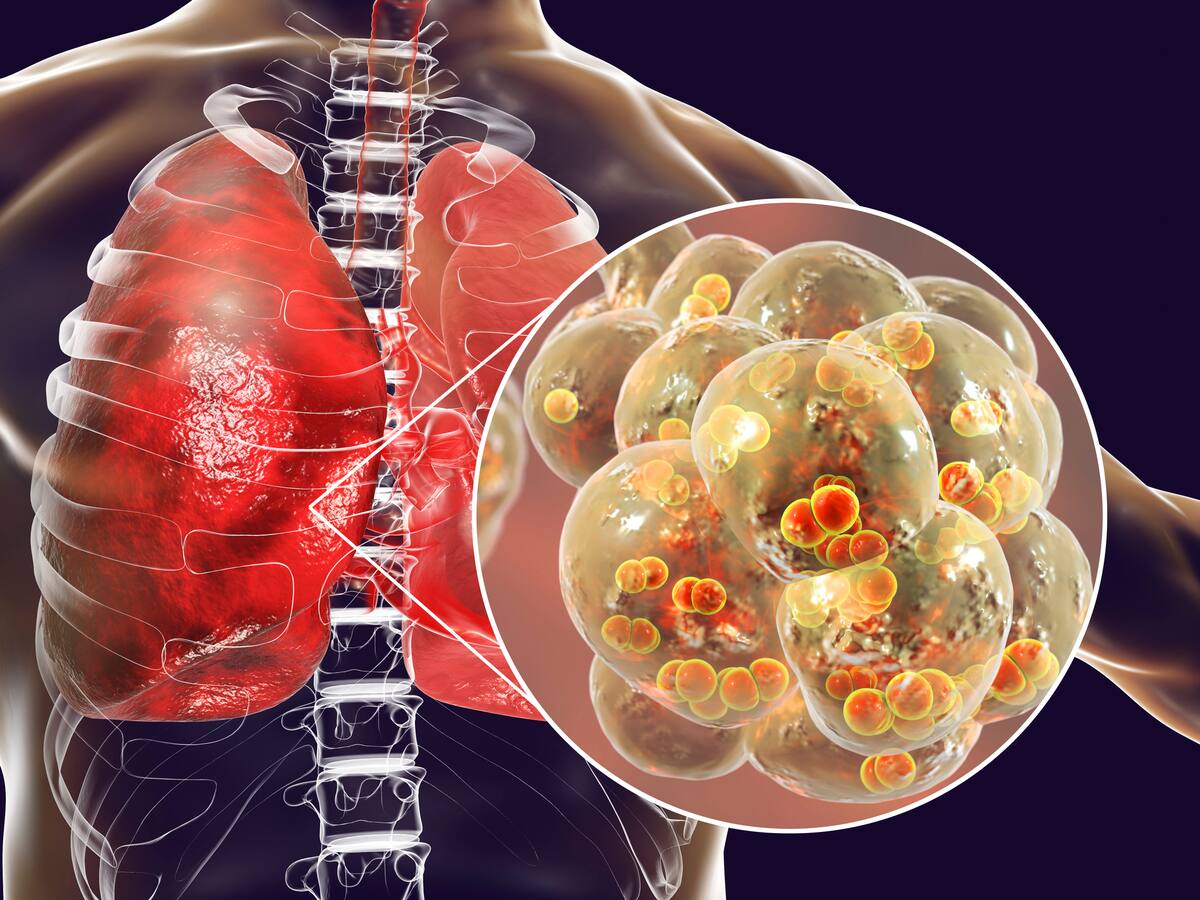 ¿Cómo se pueden prevenir las infecciones respiratorias? Médica dio consejos, cuidados y más