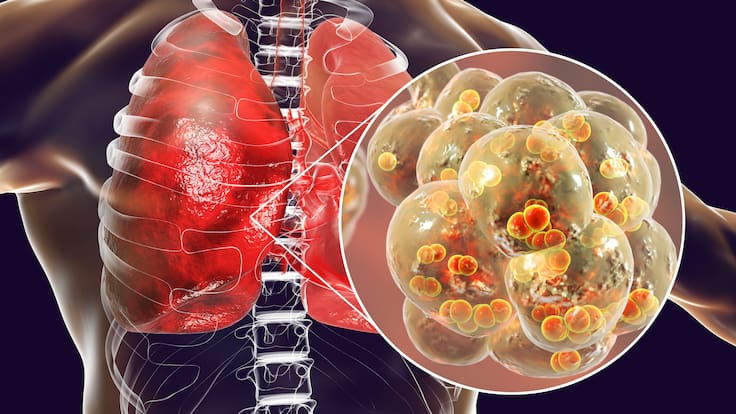 ¿Cómo se pueden prevenir las infecciones respiratorias? Médica dio consejos, cuidados y más