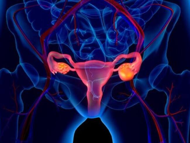 Aunque se desconoce la causa del síndrome de ovario poliquístico, se cree que puede estar relacionado con diferentes factores que actúan juntos. Foto: Getty Images