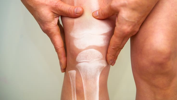 ¿La osteoporosis tiene cura? Especialista explicó