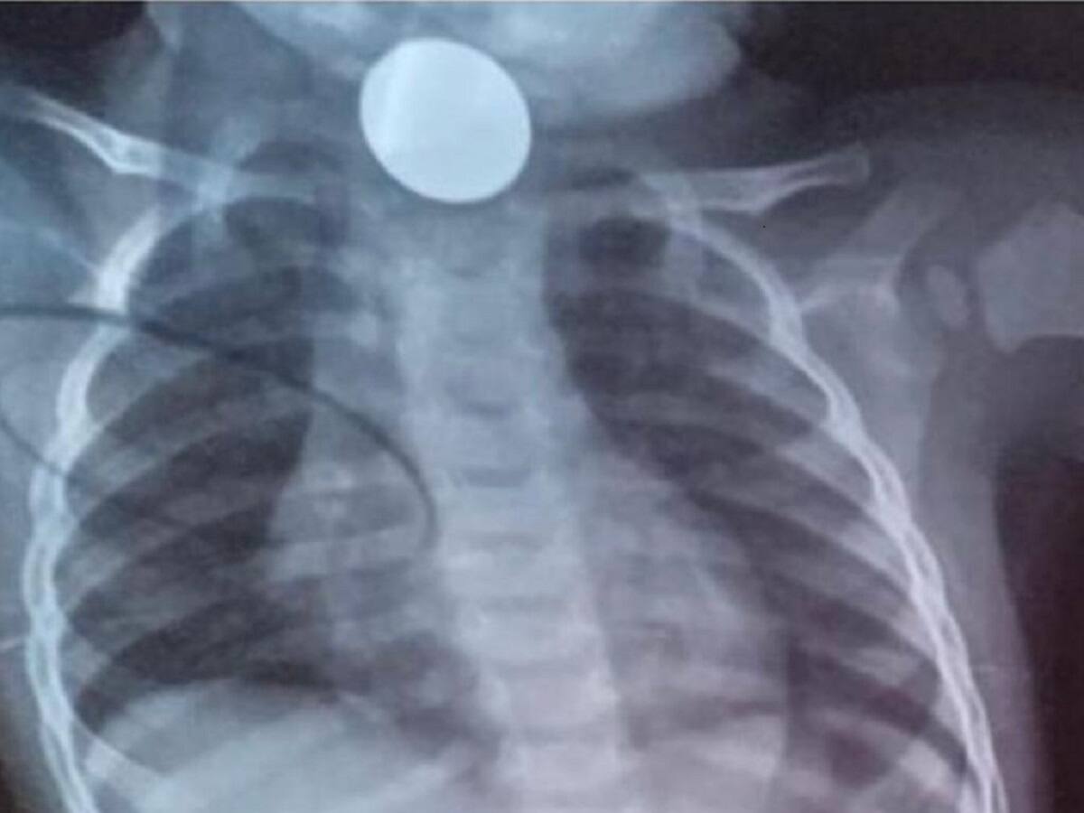 Denuncian que niño que se tragó una moneda no ha sido atendido por Asmet Salud