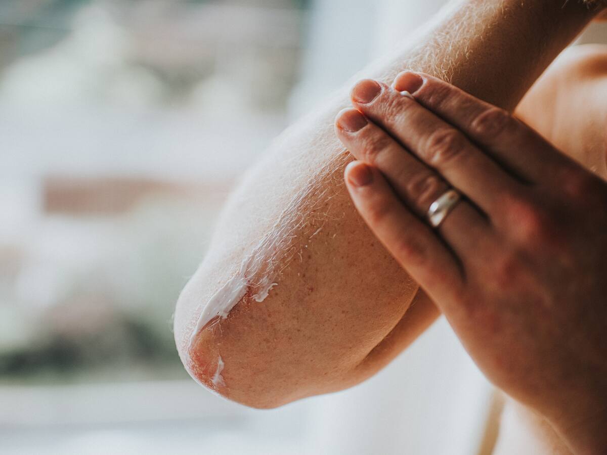 ¿Qué es la psoriasis? Estos son los tratamientos que existen para esta enfermedad de la piel