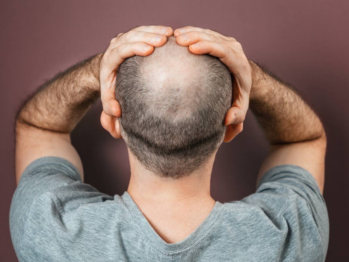 ¿Cómo reivindicar el orgullo de ser calvo? Responde el influenciador Harry James