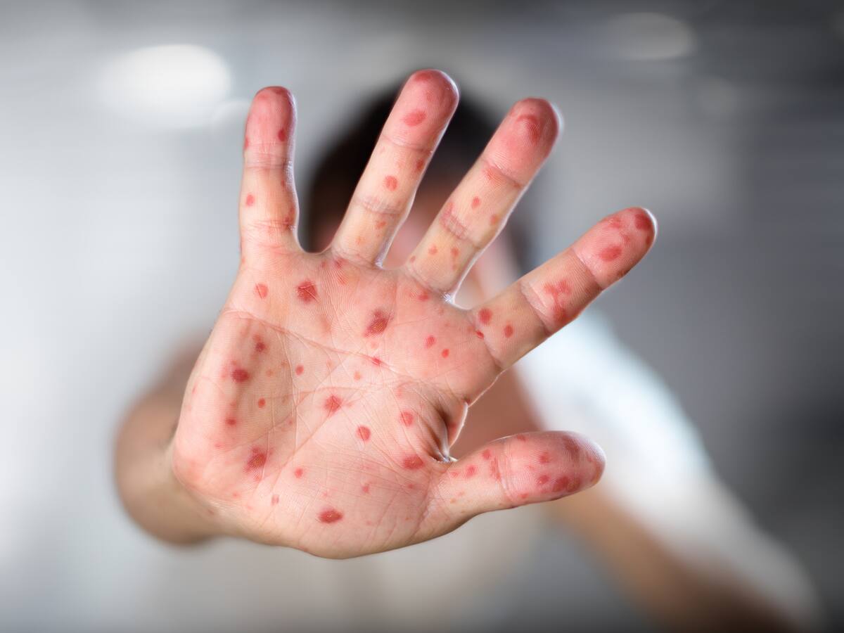 Viruela del mono: ¿qué es, cuáles son los síntomas y cómo se transmite?