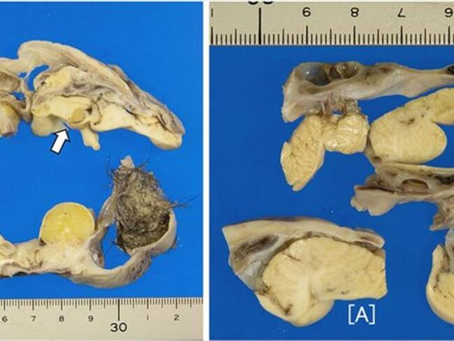 La operación de apendicitis que acabó descubriendo un cerebro en miniatura, huesos y pelo. Foto: Colprensa