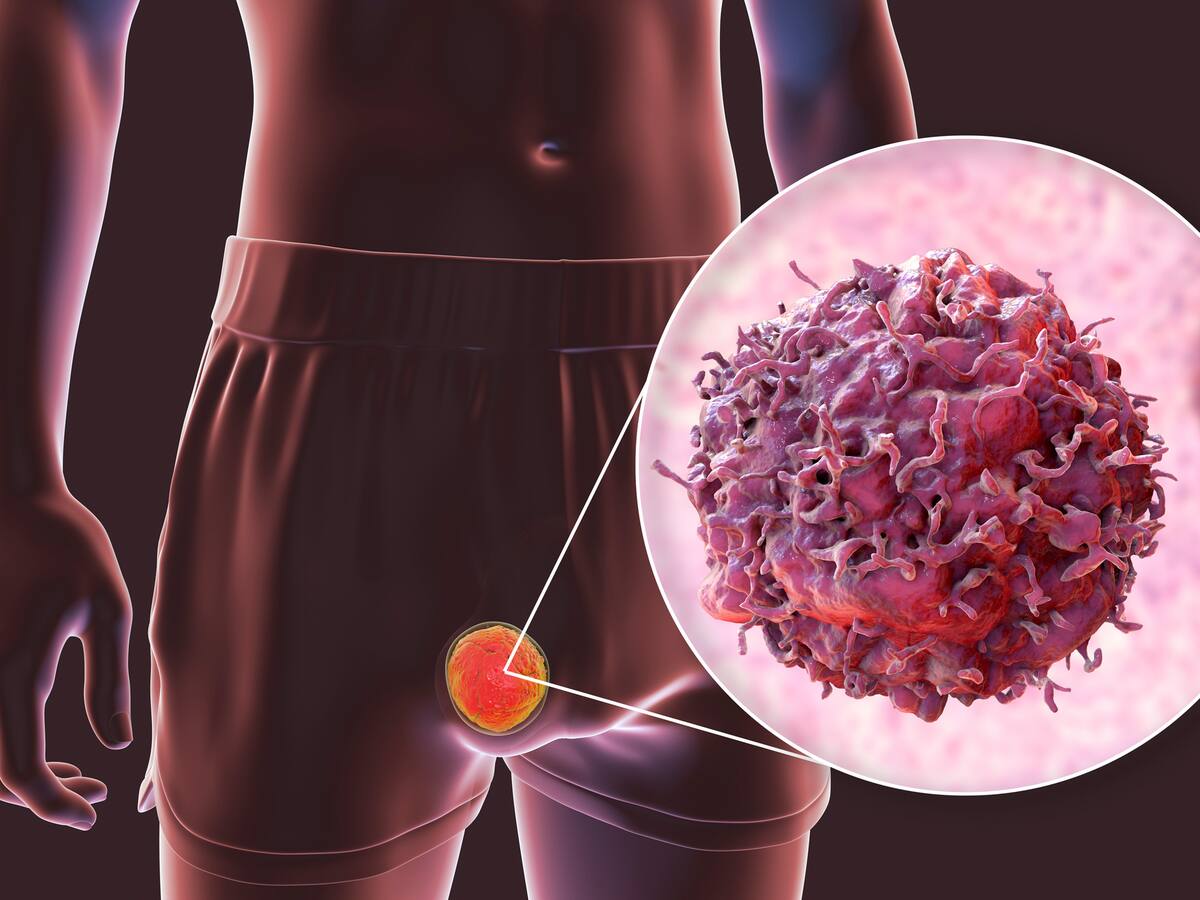 ¿Cuáles son las causas para la aparición del cáncer de pene? Así puede detectarlo