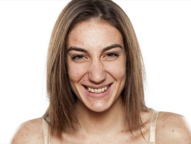 La consulta al médico es más frecuente y precoz en las mujeres que en los hombres, en una proporción que varía entre el 70% y el 80%, según el Grupo Latinoamericano de Estudio del Acné. Foto: Thinkstock