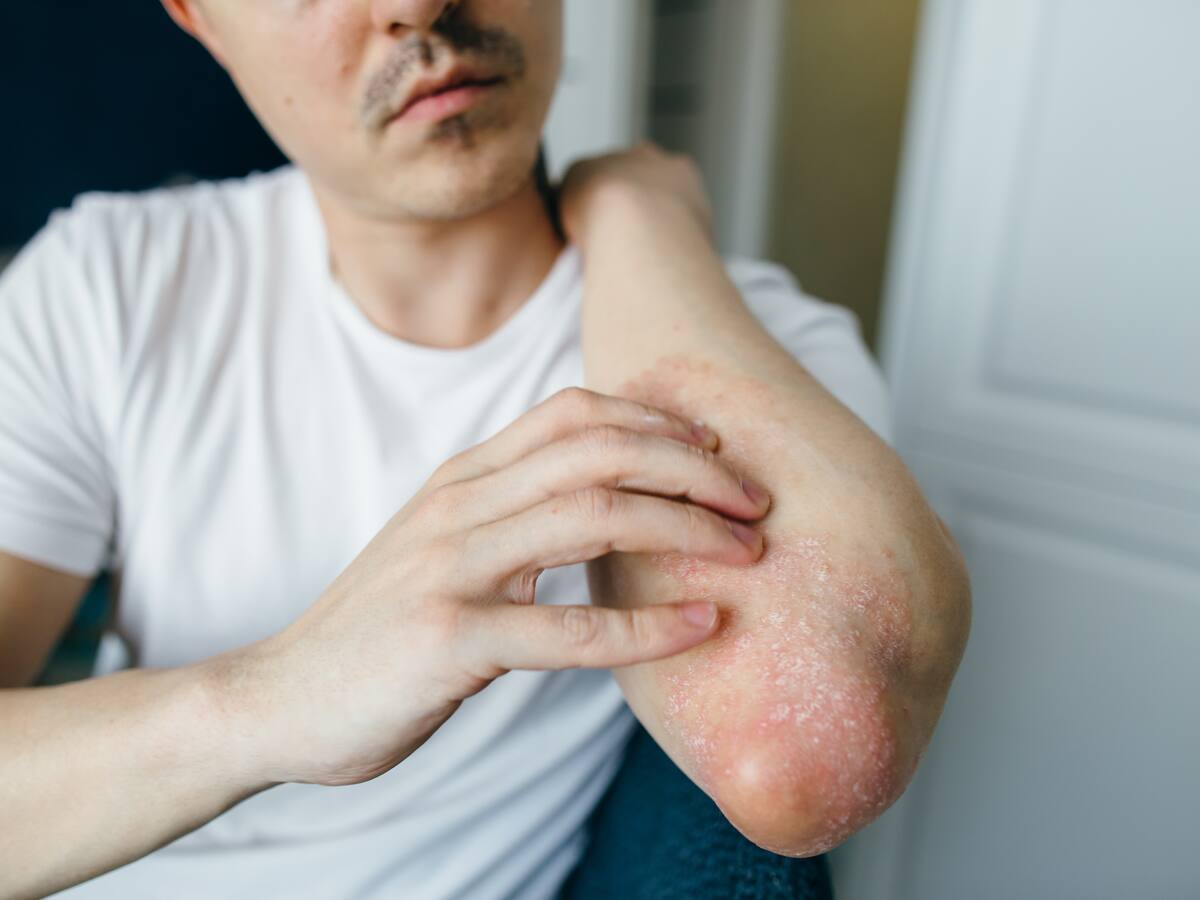 ¿Qué hacer si tiene una quemadura? Experta aclaró dudas