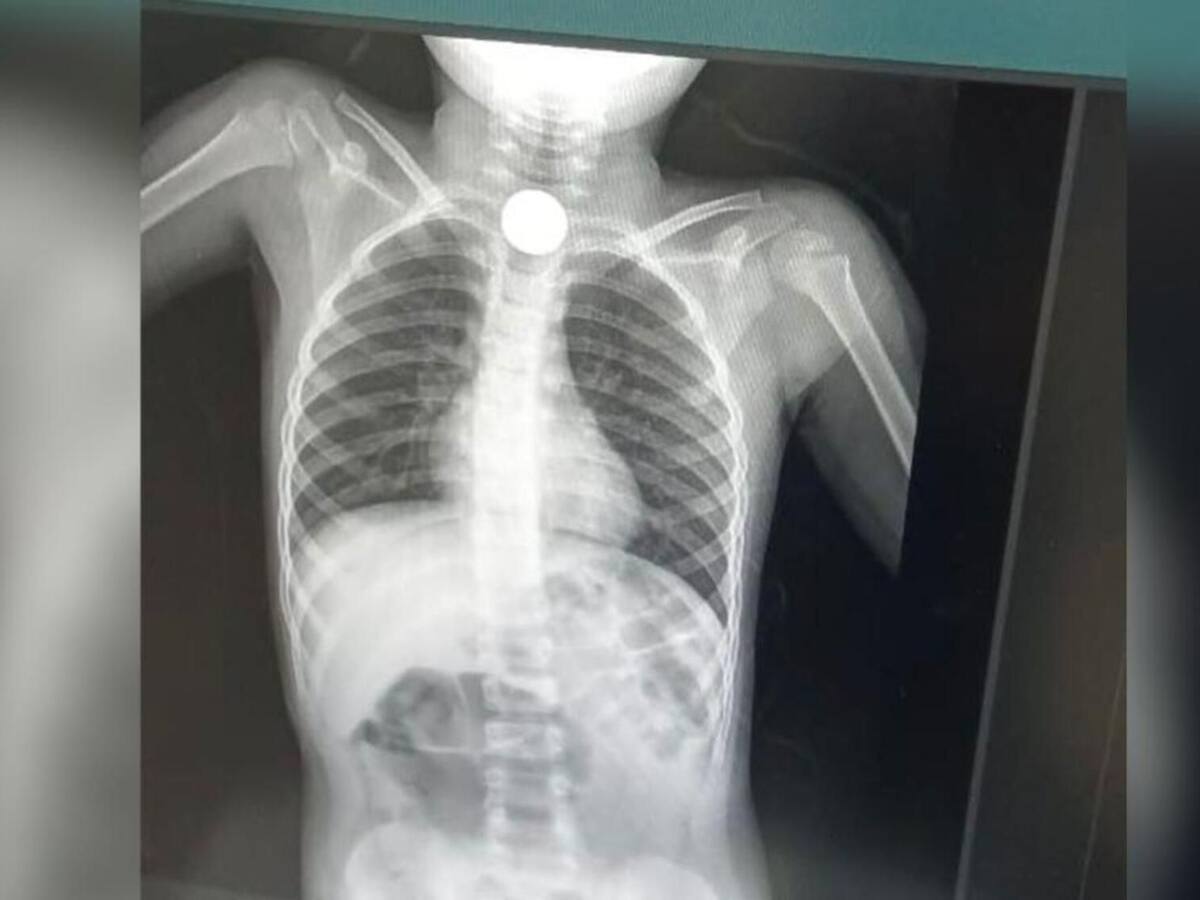 Niño se tragó dos monedas y familiares denuncian falta de atención en Magdalena